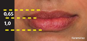 Χείλη Κανονικά αναλογία άνω/κάτω  0,65